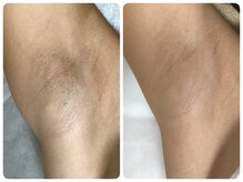 クリア 尾張旭店(Clear)/【Clear脱毛ビフォーアフター】