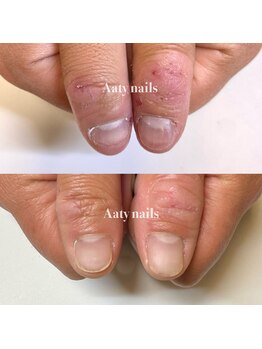 メンズ深爪矯正症例あり◎