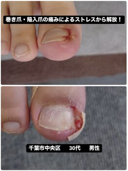 巻き爪じゅん 千葉駅前店/巻き爪・陥入爪による痛みが改善