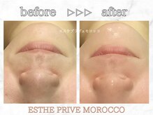エステプリヴェモロッコ(ESTHE PRIVE MOROCCO)/ポテンツァ+リジュラン