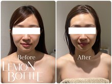 イデアルミー 大宮店(イデアルMe)/レモンボトル＆小顔コルギ