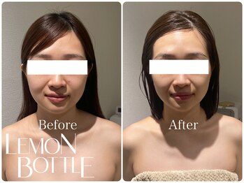 イデアルミー 大宮店(イデアルMe)/レモンボトル＆小顔コルギ