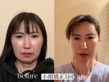 アリス(ALICE)/小顔矯正ビフォーアフター