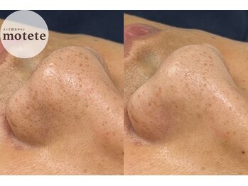モテテ 名駅店(motete)の写真/【ワックス×ハイドロケアで黒ずみ撃退！】即効で美肌を叶えます*゜