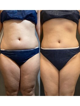 ビーバイビー(BBYB)/コアスカルプトビフォーアフター