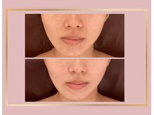 小顔美肌コルギ専門店 センティード 吉祥寺(Sentido)/『小顔美肌コルギ』3回目