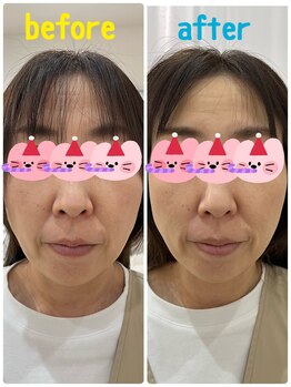 ギャラクシービューティー(galaxy beauty)/小顔矯正