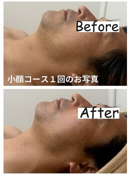 ナニワ ビューティー(naniwa beauty)/小顔WINBACK