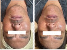 ラヴィエール(Laviere)/プラズマシャワー