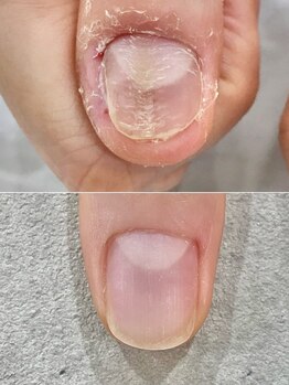 リファーレ(RIFARE)/凹凸親指