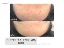 トータルクリア(TOTAL CLEAR)/ハイドラデトックス(ピーリング)