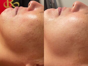 ゾーンビューティーハウス 柏店(ZONE BEAUTY HOUSE)/☆REVI陶肌トリートメント☆