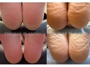 ティーダオキナワ 沖縄(THIDA OKINAWA)/ガサガサ卒業フットケア