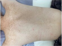 リベル 名古屋(Lebelle:)/ハーブピーリング専門　名古屋　