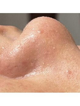 レプス(Lepus)/ハイドロ(+小鼻クレンジング)