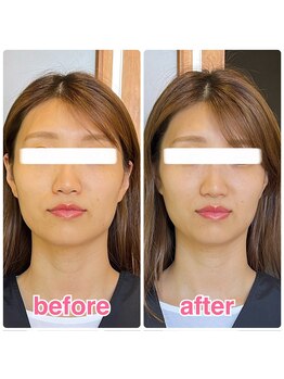 ヴィヴィアナ(viviana)/エラと頬骨をスッキリさせたい！