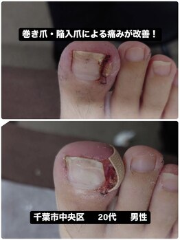 巻き爪じゅん 船橋店/巻き爪陥入爪による痛みでご来院