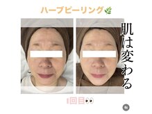 バーグトータルビューティー(bague total beauty)/ハーブピーリングヒト幹細胞注入