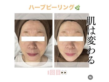 バーグトータルビューティー(bague total beauty)/ハーブピーリングヒト幹細胞注入