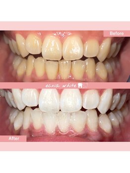 エクシアホワイトニング 札幌琴似店/ホワイトニングビフォーアフター