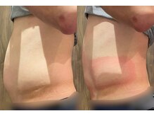 ビュウナ 銀座(BEAUNA)/脂肪冷却/frozen8