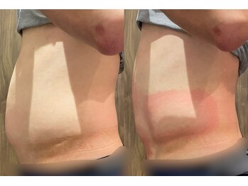 ビュウナ 銀座(BEAUNA)/脂肪冷却/frozen8