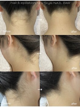 エムズスタイル ネイルバー(M's Style NAIL BAR)/うなじ脱毛