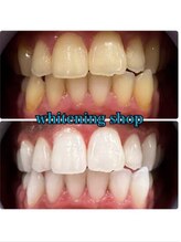 ホワイトニングショップ 鳥取店/ホワイトニングビフォーアフター