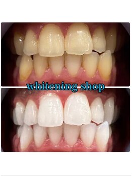 ホワイトニングショップ 鳥取店/ホワイトニングビフォーアフター