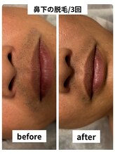 ゼロミリメートル(0mm)/【脱毛】ビフォーアフター