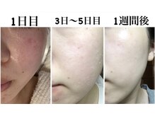 サロン ド ボーテ ラーンジュ 岐阜店(salon de beaut'e L'ange)/本気の肌改善毛穴、ニキビ、小顔