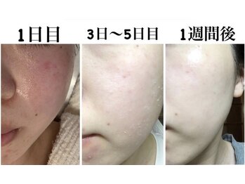 サロン ド ボーテ ラーンジュ 岐阜店(salon de beaut'e L'ange)/本気の肌改善毛穴、ニキビ、小顔