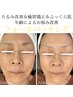 【たるみ改善・輪郭矯正】お肌ふっくらエイジングケア～フォーエバーヤング～