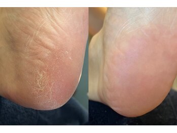 メグムサロン(Megumu Salon)/空ルート/角質/マッサージ