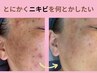 【ニキビ】繰り返すニキビやブツブツ凸凹肌を本気で改善したい方 初回体験