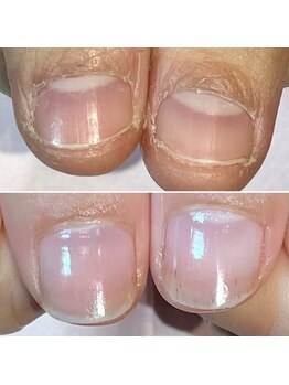 ココデネイル(cocode nail)/悩み:爪噛み(20代前半)その1