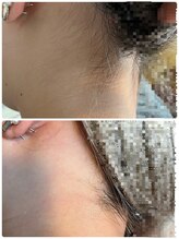 ノノ(nono)/うなじ脱毛！