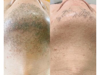 エクレ(EKURE)/男性ヒゲ脱毛