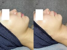 エモーショナル 姫路(Emotional)/ララピール×LDM【毛穴/艶肌】