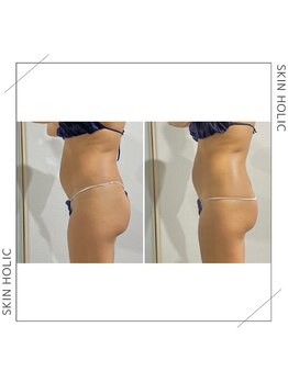 スキンホリック 恵比寿駅前店(SKIN HOLIC)/お腹☆ビフォア＆アフター★