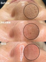 グラーティア 奈良王寺店/毛穴洗浄★1回後★