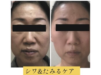 ビューティースパ/娘さんに褒められる小顔♪