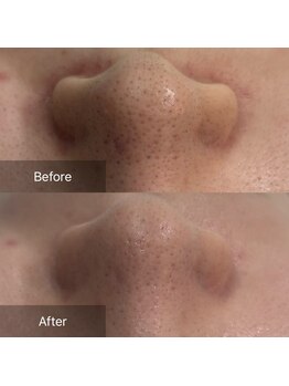 サムライの美/毛穴ケア症例写真