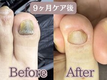 ポドロ(PoDoLo)の雰囲気（【分厚い爪】ずっとこの爪のままだと諦めかけてた足の爪）