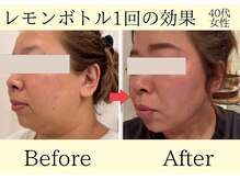 エトワール(etoile)/レモンボトル・小顔脂肪分解