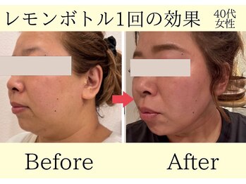 エトワール(etoile)/レモンボトル・小顔脂肪分解
