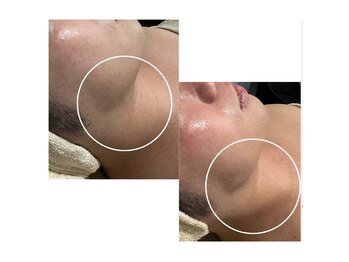 ファロンビューティー(fallon beauty)/キャビMaxフェイシャルコース