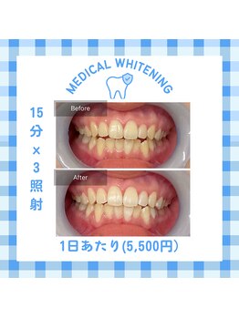 ベルプラス 新大阪(Belle plus)/￥5,500ホワイトニング