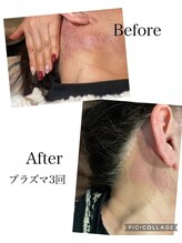 リジューブ(Rejuve)/プラズマ