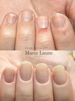 マリーロール 淀屋橋本店(Marie Laure)/自爪育成/深爪矯正/ネイルケア